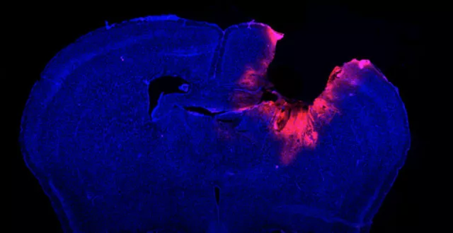 glioblastoma.png